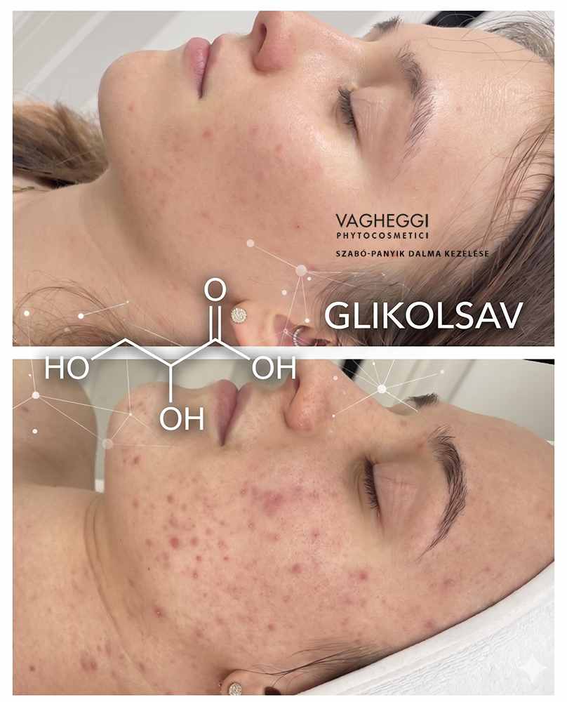 Glikolsav hat&aacute;sa a bőrre előtte ut&aacute;na &ndash; sim&aacute;bb &eacute;s ragyog&oacute;bb bőrfelsz&iacute;n