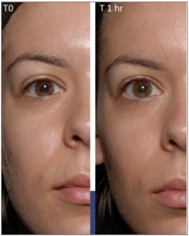 K&ouml;nnyű text&uacute;r&aacute;j&uacute; hidrat&aacute;l&oacute; kr&eacute;m zs&iacute;ros bőrre, amely seg&iacute;t cs&ouml;kkenteni a f&eacute;nylő &eacute;rzetet